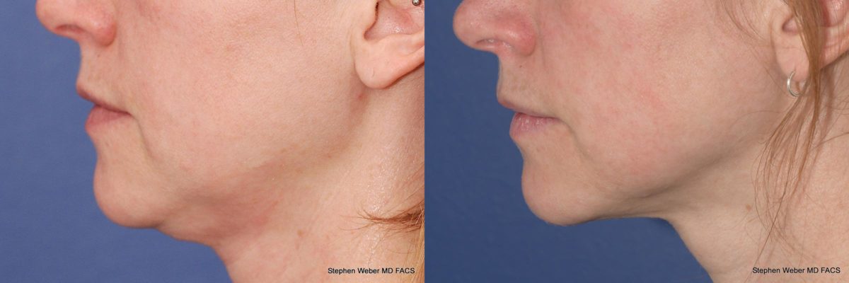 Kybella Before and After | Weber Facial Plastic Surgery