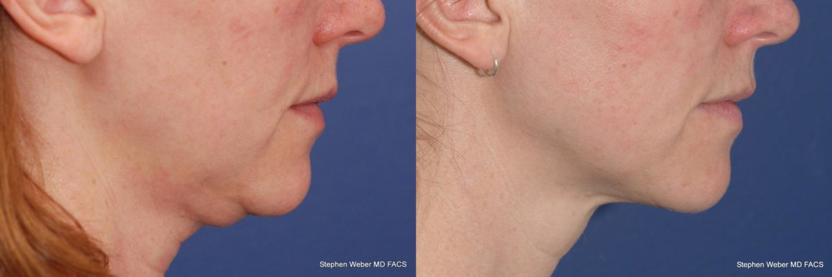 Kybella Before and After | Weber Facial Plastic Surgery
