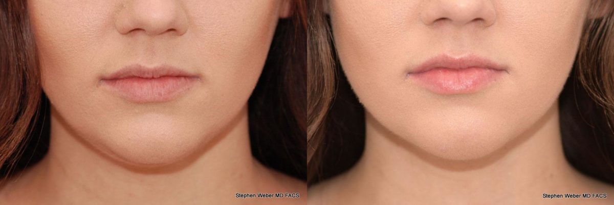 Kybella Before and After | Weber Facial Plastic Surgery