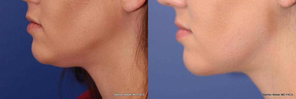 Kybella Before and After | Weber Facial Plastic Surgery