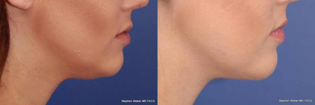 Kybella Before and After | Weber Facial Plastic Surgery