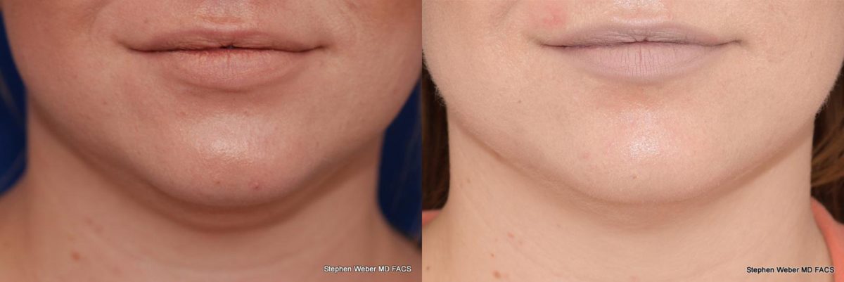 Kybella Before and After | Weber Facial Plastic Surgery