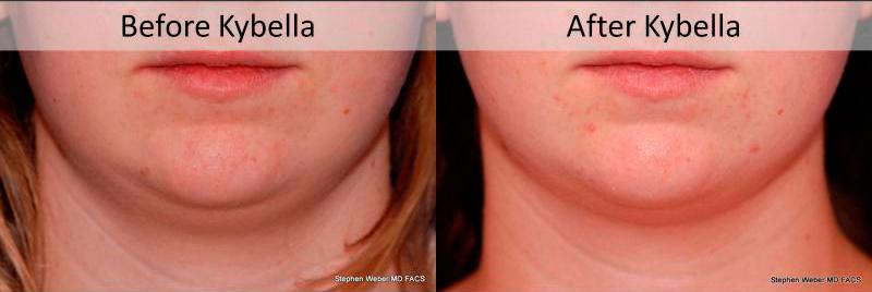 Kybella Before and After | Weber Facial Plastic Surgery