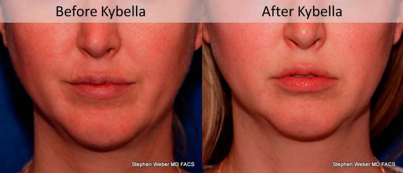 Kybella Before and After | Weber Facial Plastic Surgery