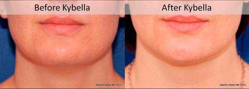 Kybella Before and After | Weber Facial Plastic Surgery