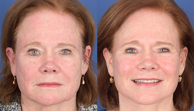 Laser Resurfacing Before and After | Weber Facial Plastic Surgery