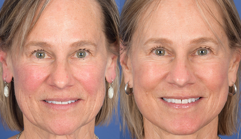 Laser Resurfacing Before and After | Weber Facial Plastic Surgery