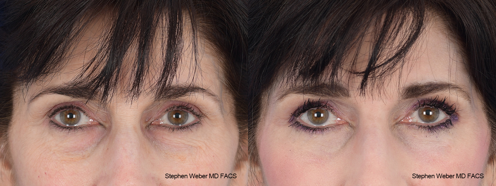 Laser Resurfacing Before and After | Weber Facial Plastic Surgery