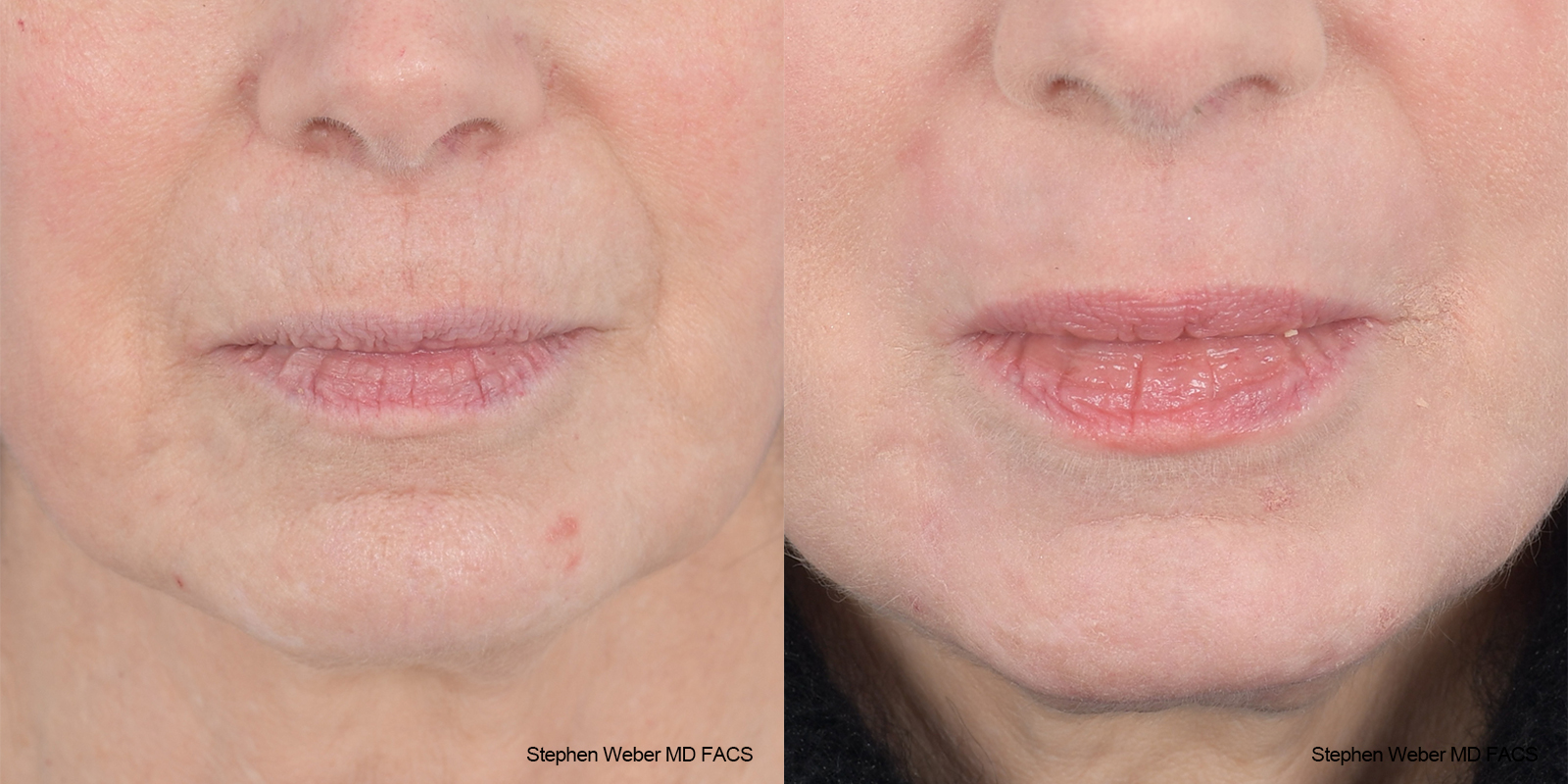Laser Resurfacing Before and After | Weber Facial Plastic Surgery