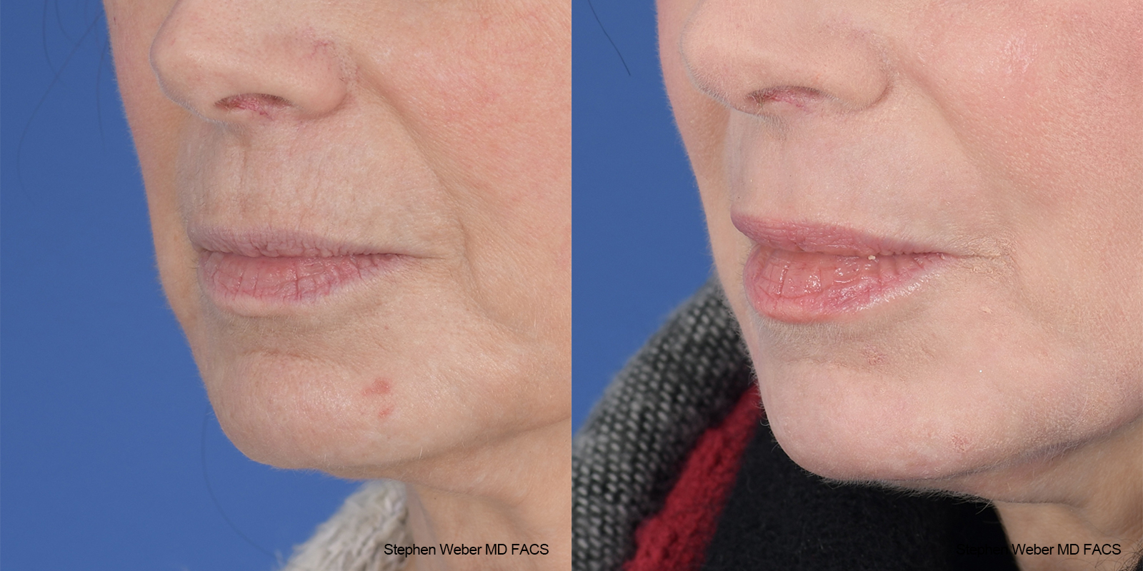 Laser Resurfacing Before and After | Weber Facial Plastic Surgery