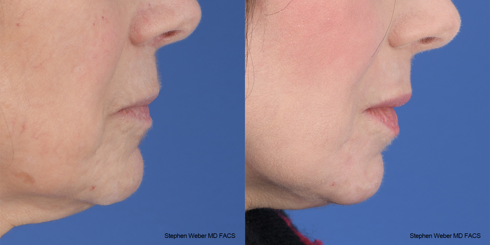 Laser Resurfacing Before and After | Weber Facial Plastic Surgery