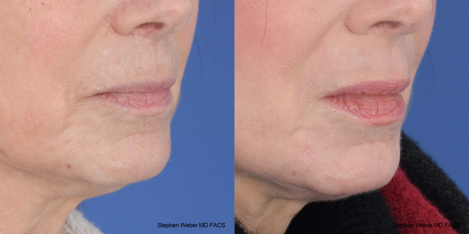 Laser Resurfacing Before and After | Weber Facial Plastic Surgery
