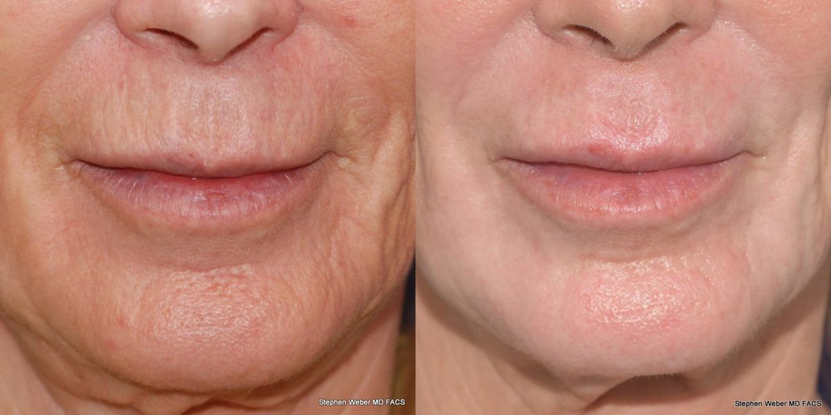 Laser Resurfacing Before and After | Weber Facial Plastic Surgery