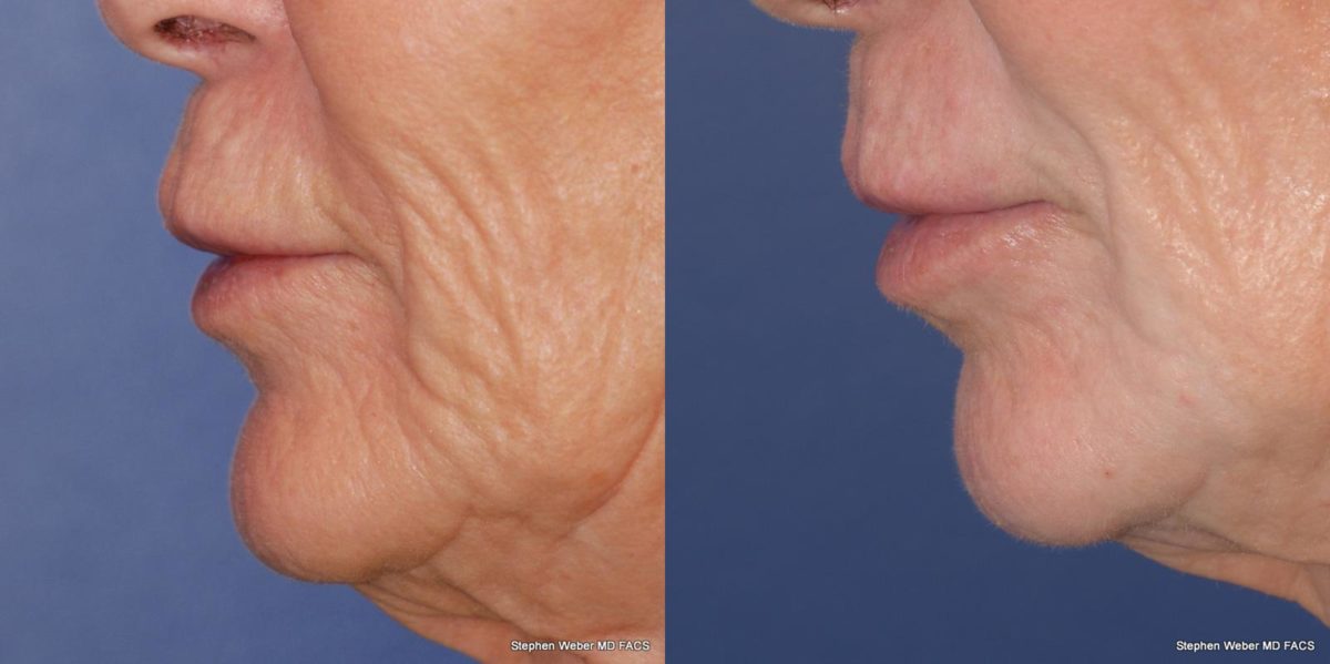 Laser Resurfacing Before and After | Weber Facial Plastic Surgery
