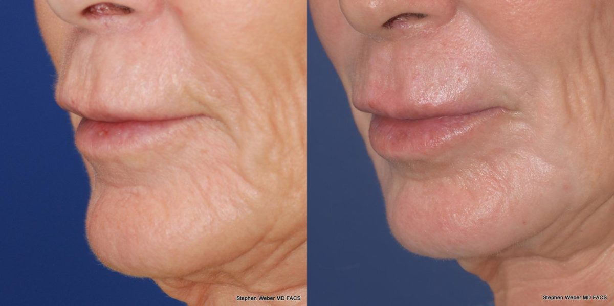 Laser Resurfacing Before and After | Weber Facial Plastic Surgery