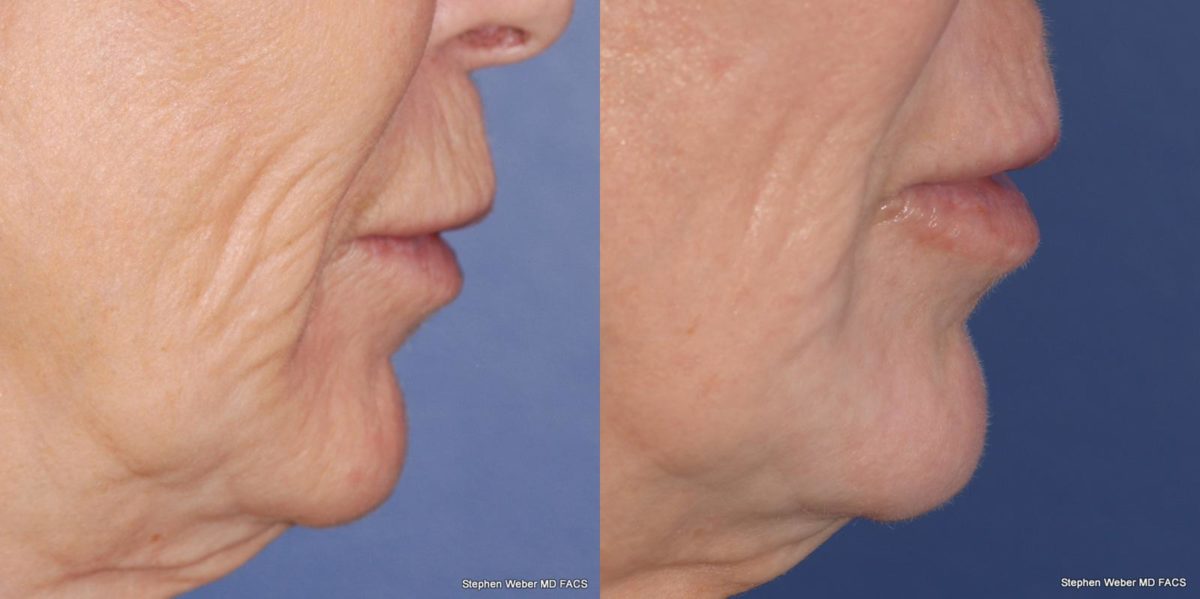Laser Resurfacing Before and After | Weber Facial Plastic Surgery