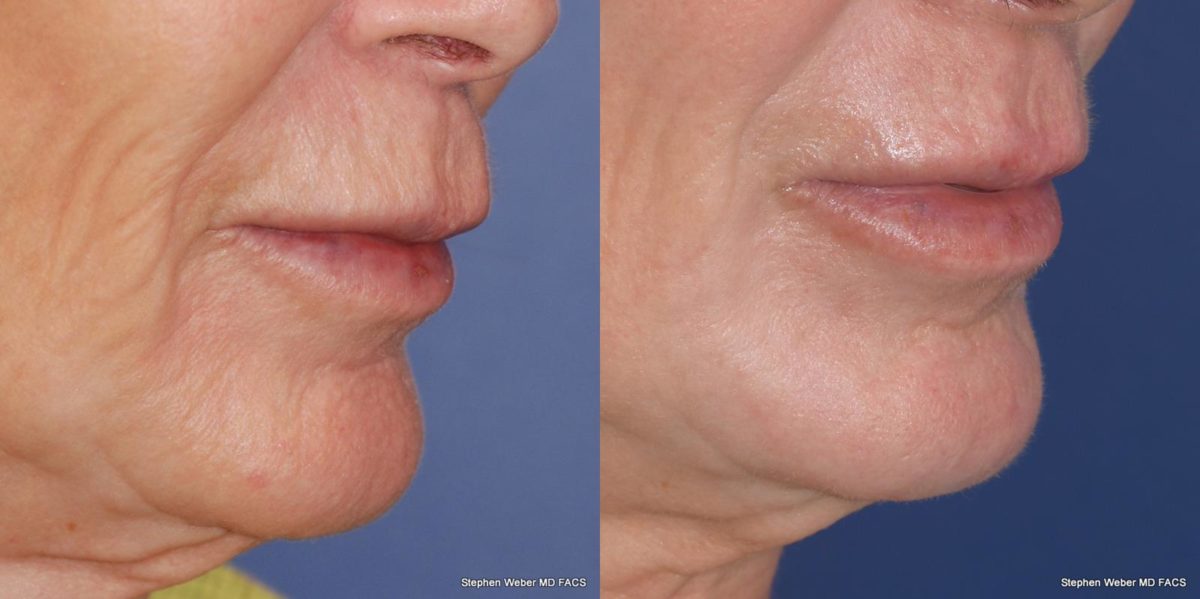 Laser Resurfacing Before and After | Weber Facial Plastic Surgery
