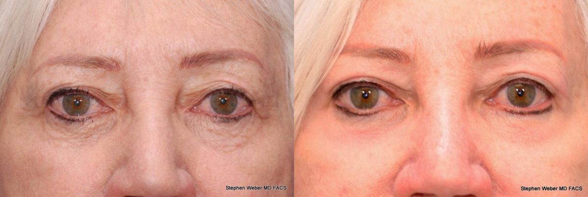 Laser Resurfacing Before and After | Weber Facial Plastic Surgery