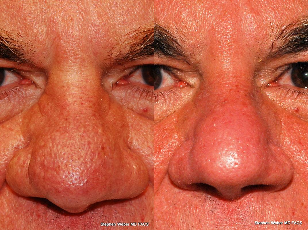 Laser Resurfacing Before and After | Weber Facial Plastic Surgery