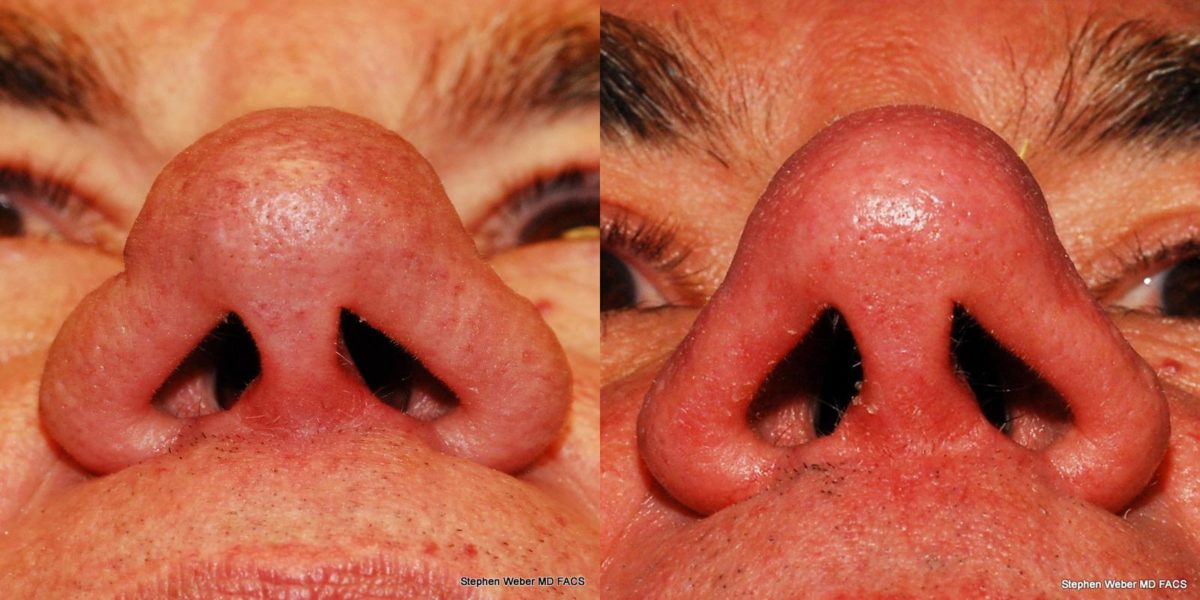 Laser Resurfacing Before and After | Weber Facial Plastic Surgery