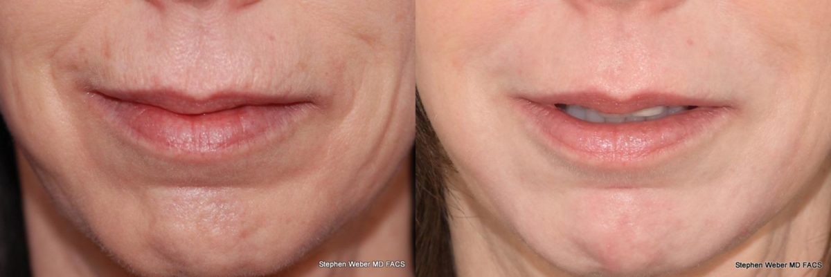 Laser Resurfacing Before and After | Weber Facial Plastic Surgery