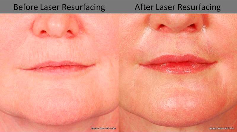 Laser Resurfacing Before and After | Weber Facial Plastic Surgery