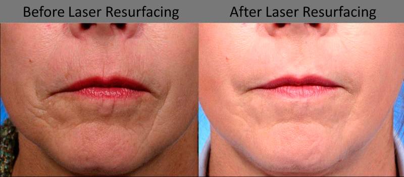 Before and After Laser Skin Resurfacing in Denver 1
