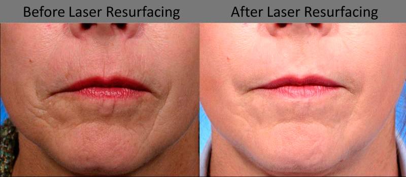 Laser Resurfacing Before and After | Weber Facial Plastic Surgery