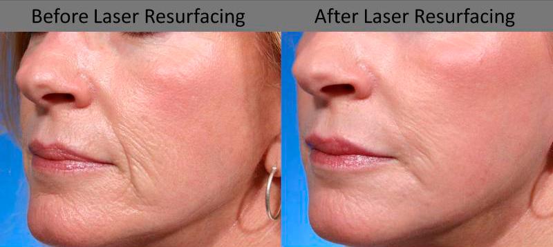 Laser Resurfacing Before and After | Weber Facial Plastic Surgery