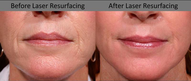 Laser Resurfacing Before and After | Weber Facial Plastic Surgery