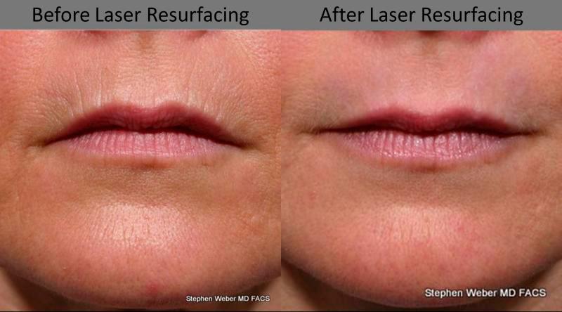 Laser Resurfacing Before and After | Weber Facial Plastic Surgery