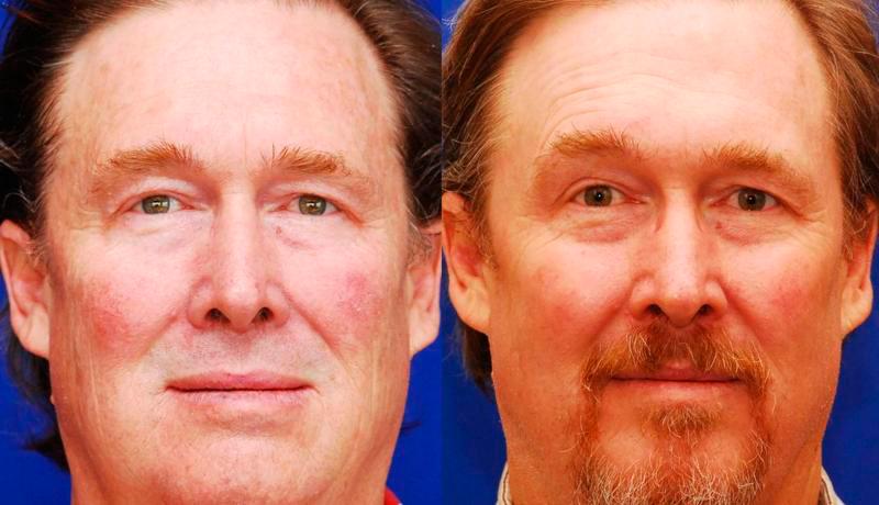 Laser Resurfacing Before and After | Weber Facial Plastic Surgery