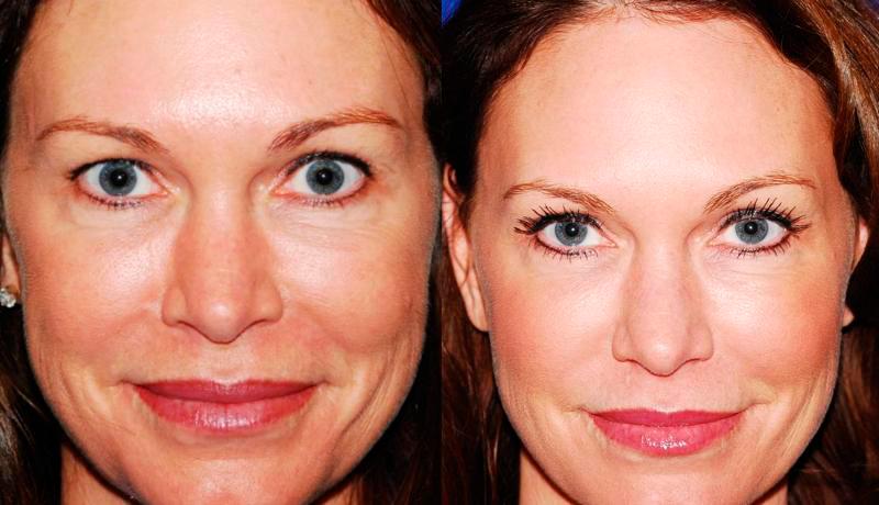 Laser Resurfacing Before and After | Weber Facial Plastic Surgery