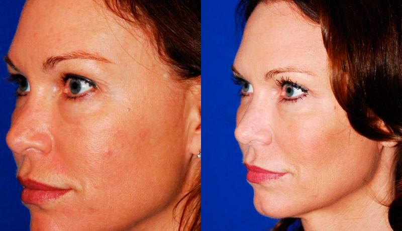 Laser Resurfacing Before and After | Weber Facial Plastic Surgery