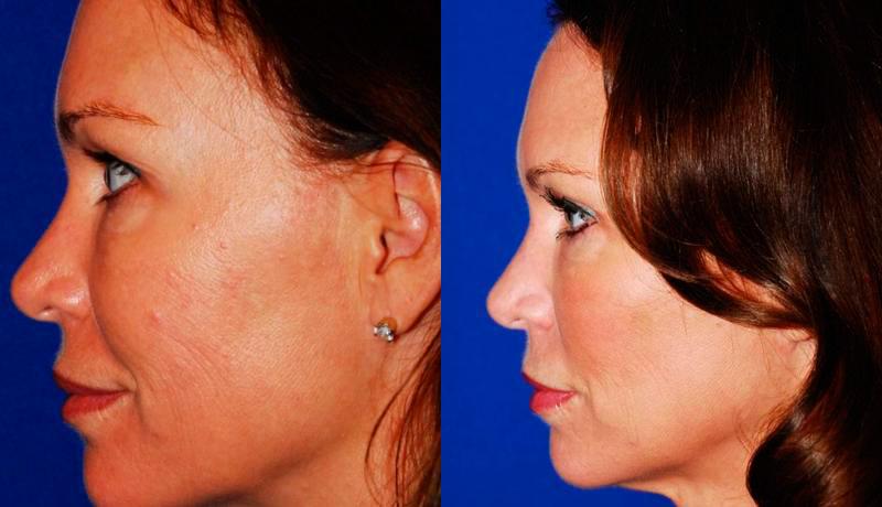 Laser Resurfacing Before and After | Weber Facial Plastic Surgery