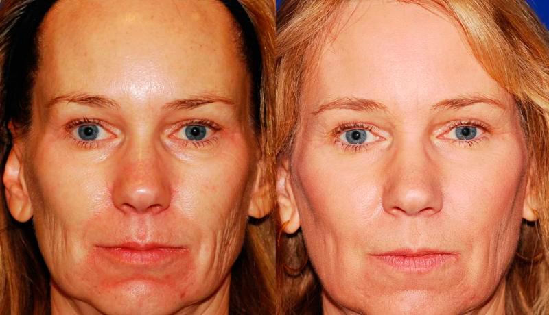 Laser Resurfacing Before and After | Weber Facial Plastic Surgery