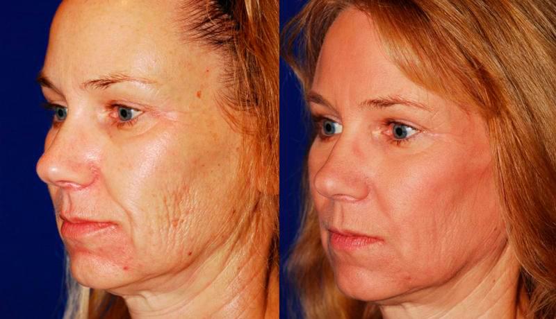 Laser Resurfacing Before and After | Weber Facial Plastic Surgery