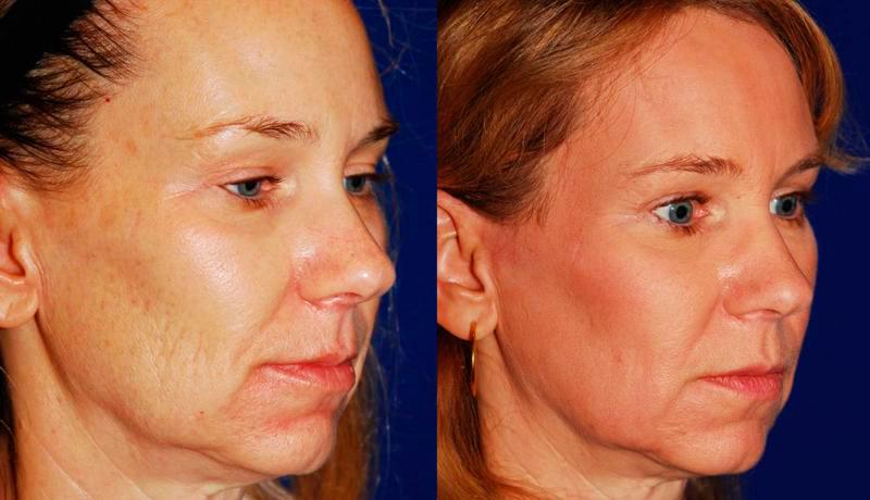 Laser Resurfacing Before and After | Weber Facial Plastic Surgery