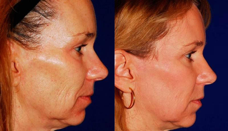 Laser Resurfacing Before and After | Weber Facial Plastic Surgery
