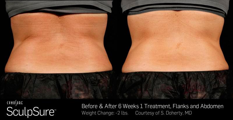 Sculpsure Before and After | Weber Facial Plastic Surgery