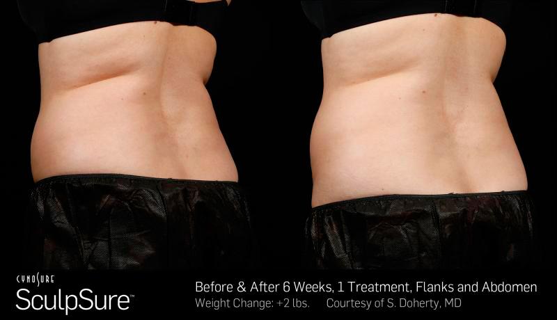 Sculpsure Before and After | Weber Facial Plastic Surgery