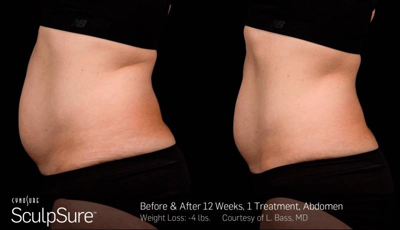 Sculpsure Before and After | Weber Facial Plastic Surgery
