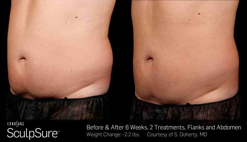 Sculpsure Before and After | Weber Facial Plastic Surgery
