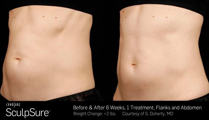 Sculpsure Before and After | Weber Facial Plastic Surgery