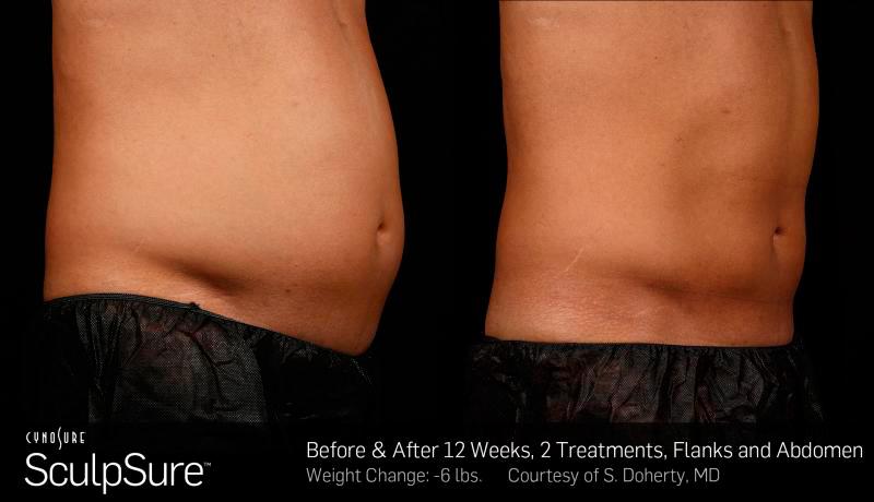 Sculpsure Before and After | Weber Facial Plastic Surgery
