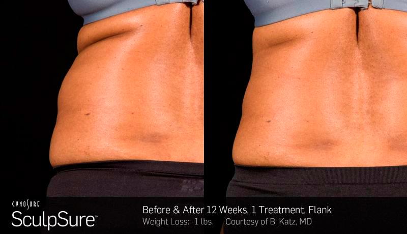 Sculpsure Before and After | Weber Facial Plastic Surgery