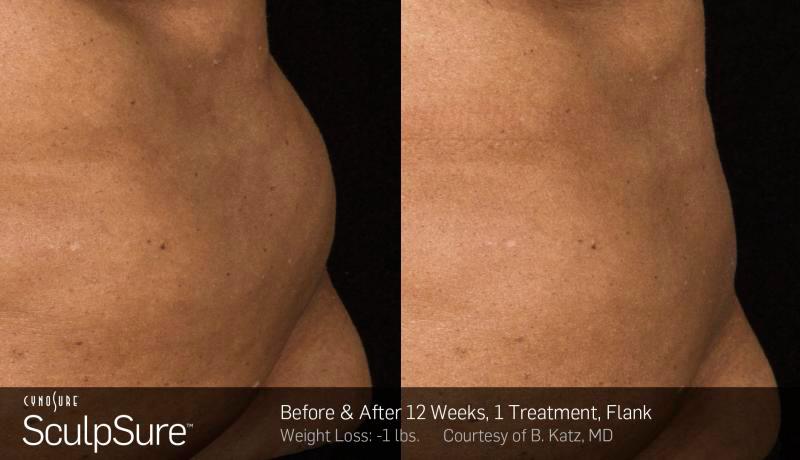 Sculpsure Before and After | Weber Facial Plastic Surgery
