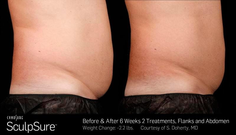 Sculpsure Before and After | Weber Facial Plastic Surgery