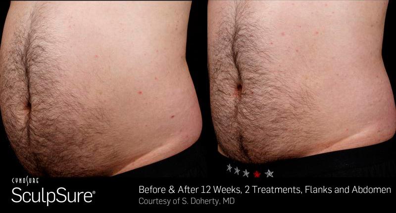 Sculpsure Before and After | Weber Facial Plastic Surgery