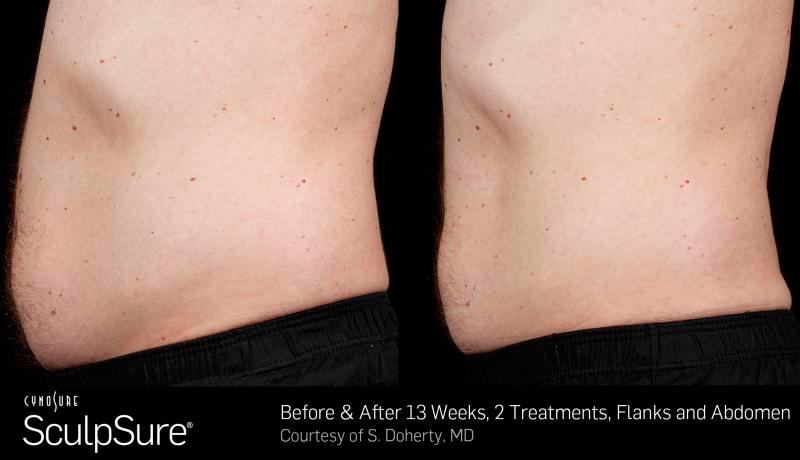 Sculpsure Before and After | Weber Facial Plastic Surgery